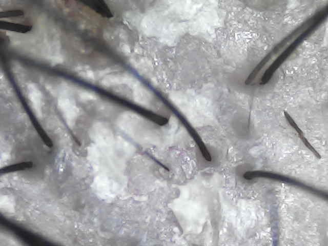Scalp seen through the NioScope before a scalp care appointment at ELM, Wrexham